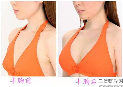 豐乳什么技術(shù)比較不錯 _豐乳功效如何 