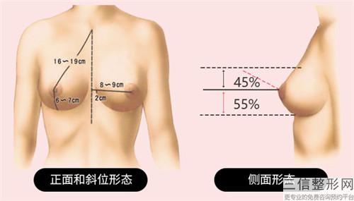 小胸美胸之后效果理想嗎_美胸效果自然嗎