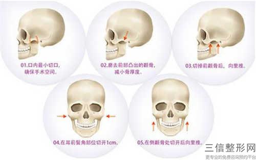 削骨手術都有哪些后遺癥