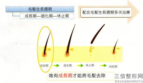 激光脫毛術成效好不好