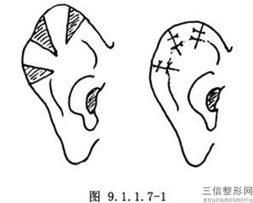 矯正不良耳部形態的比較終價格_進行一次矯正不良耳部形態應需要多少元左右？