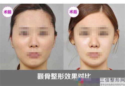 這文章女士們在實(shí)行頜骨整容完成以前必須要看看