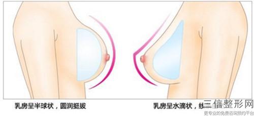 兩側的乳頭不對稱是乳頭凹陷矯正的不良后果嗎？