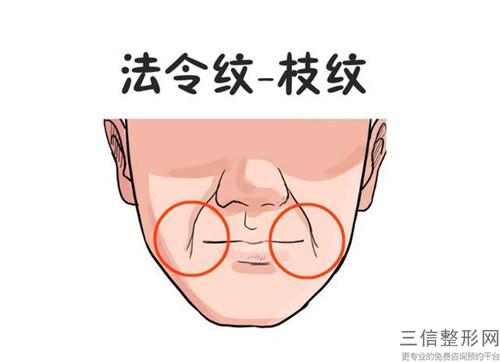 蛋白鋸齒線懸吊緊致除皺方法的真正作用